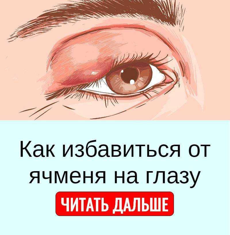 Сколько проходит ячмень на глазу: как долго длится заболевание, может ли заболевание исчезнуть само, через сколько дней необходимо обратиться к врачу
